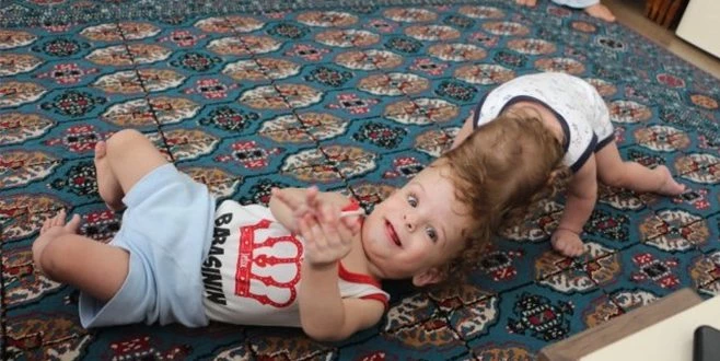 KAFADAN YAPIŞIK İKİZLER 1 YAŞINDA