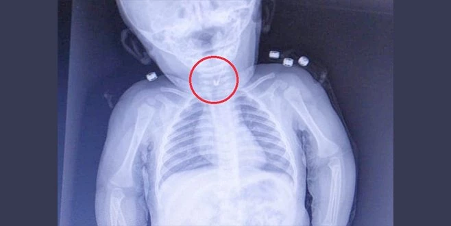 7 AYLIK BEBEĞİN YEMEK BORUSUNDAN ÇENGELLİ İĞNE ÇIKTI